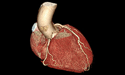 Coronary CTA