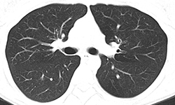 Low-dose Lung Cancer Screening - With Lung Nodules