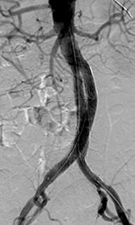 AAA Stent-graft
