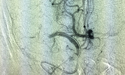 MCA Stroke